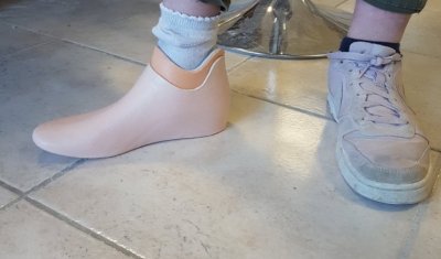 Fabrication de prothèse de pied à Perpignan