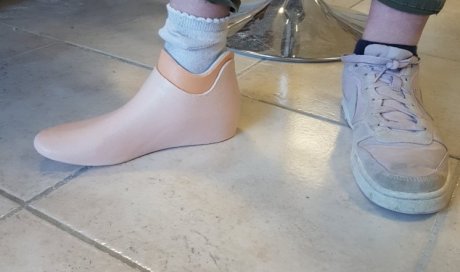 Fabrication de prothèse de pied à Perpignan